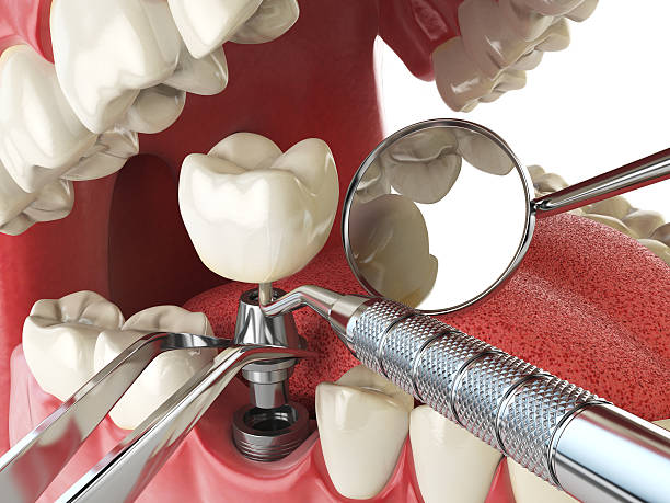 Best Emergency Treatment for Oral Infections in Platteville, CO